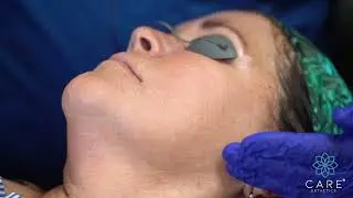 Vector Lifting on Lower face by CARE Esthetics