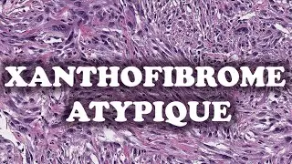 LE FIBROXANTHOME ATYPIQUE - PATHOLOGIE