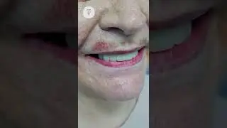 Удалено 14 зубов 6 имплантатов 2 синуса за 2 визита к стоматологу. Имплантация зубов.