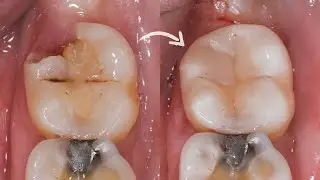 Composite filling last molar