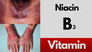 Vitamin B3 (Niacin) deficiency symptoms, food sources and benefits of the B3 vitamin
