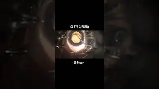 icl eye surgery for -15 power 