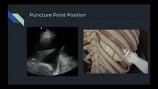 Ultrasound Guided Thoracentesis