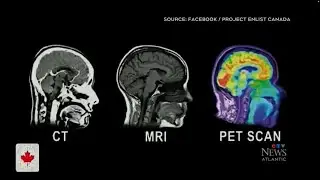 Researchers investigating head trauma in the Canadian military want veterans to 'pledge their brain'