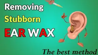 EAR WAX REMOVAL | The SAFEST and MOST EFFECTIVE Way To Get Rid Of STUBBORN Ear Wax At Home