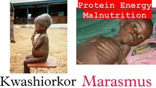Protein Energy Malnutrition | Kwashiorkor | Marasmus || Mis.Medicine