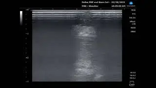Ultrasound video 6 mos after a repair of a large rotator cuff tear augmented with Biobrace graft