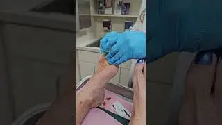 Hammertoe Tendon Release -- No blade, no sutures! #toppodiatrist #floridapodiatrist #fflc