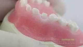 Pediatric Zirconia Crown Technique | Cuspid