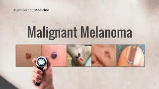 Malignant Melanoma