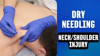 Dry Needling for Neck & Shoulder Pain Relief: Patient Demo