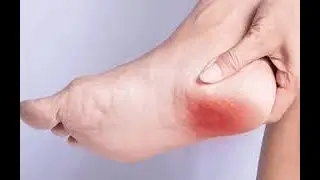 Куда ставить пиявки при пяточной шпоре?