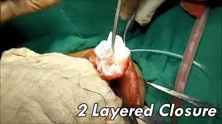 Chin Augmentation | Chin Implant, Permanent Makeup, Facemakeover Treatment in Athwagate, Vesu, Surat