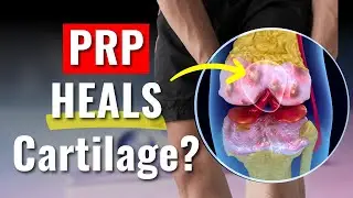 The Untold Secret of PRP Injections for Knee Pain