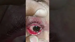 Diagnosis? #eye #disease #eyecare #optometry #shorts #trending @eyecare