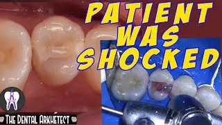 Tooth Restoration Patient Complained on an existing Tooth Restoration (PASTA) #C8