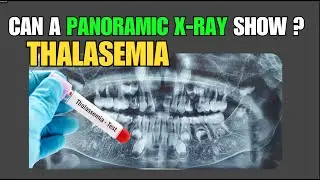 OPG can show THALASSEMIA !!!/ Thalassemia panoramic / Thalassemia sign on panoramic radiographs