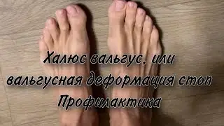 Халюс вальгус, или вальгусная деформация стоп  Как помочь