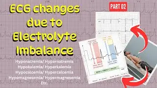 Electrolyte Imbalance & its impact on ECG Changes | Hypomagnesemia & Hypermagnesemia  |  Part 2