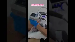 Hifu y Exilis - Tensado facial sin agujas