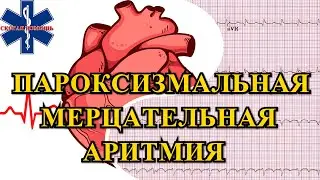 Пароксизмальная мерцательная аритмия