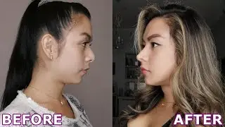 PLASTIC SURGERY IN KOREA : FACIAL FEMINIZATION SURGERY(FFS) PT.2