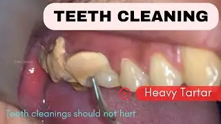 Heavy Tartar cleaning | Stain, Tartar Removal by doctor | Professional teeth cleaning | your dentist