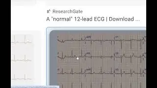 ecg 3