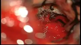 3  ventricle giant tumor transcallosal approach 1708883