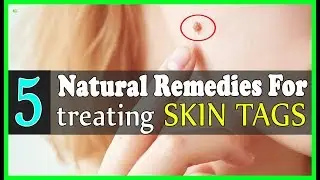 5 Effective Natural Remedies For Treating Skin Tags - How To Get Rid Of Skin Tags?