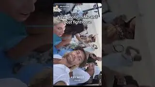 Micah Plath's New Nose Post-Fight
