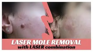 Mole evaporation with LASER combination - Plastic Surgeon
