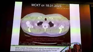 Бронхо 30 03 Маменко ИС Случай центрального образования бронха после EBUS TBNA