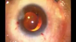 Facoemulsificación de catarata con pérdida de vítreo insertando el Lente Introcular