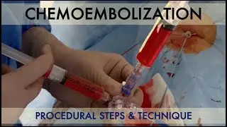 Trans-Arterial Chemoembolization (TACE) procedure: procedural steps and technique