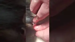 extraction of deciduous tooth