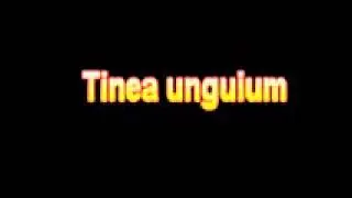 What Is The Definition Of Tinea unguium