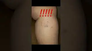 СКЛЕРОТЕРАПИЯ