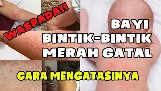 (SHARE PENGALAMAN) WASPADA!! BINTIK MERAH GATAL PADA BAYI