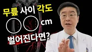 [연세사랑병원] 무릎안쪽통증, O다리 먼저일까? 연골손상이 먼저일까? 원인과 증상 살펴보기!
