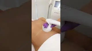 CONTOUR Abdomen