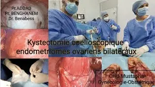 Kystectomie coelioscopique pour endometriomes ovariens bilatéraux