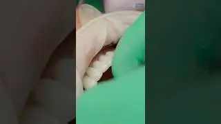 "What are the benefits of screw-retained implant bridges?"🤔🦷 #shorts #dentalimplants #smilemakeover