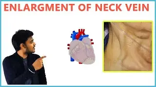 JUGULAR VENOUS PRESSURE | CAUSES FOR ENLARGEMENT OF NECK VEINS | BULGING OF NECK VEINS || RJDS MEDIX