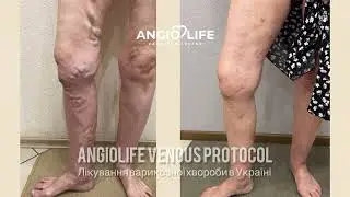 Результат лікування варикозу в АНГІОЛАЙФ