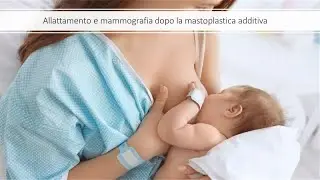 Allattamento e mammografia dopo la mastoplastica, é possibile? || Dr Montemurro - Chirurgo Plastico