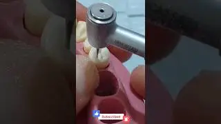 ازالة تسوس كلاس ١ #dr_ghazal #preparation