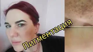 Неочевидные причины пигментации. Как осветлить кожу.