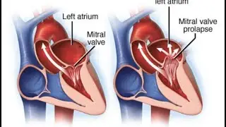 Mitral Valve Prolapse