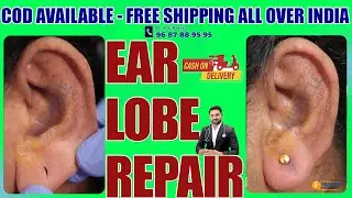 Ear lobe Correction / Without Stitches Ear lobe Treatment -कान का बड़ा छेद ठीक करने का आसान तरीका